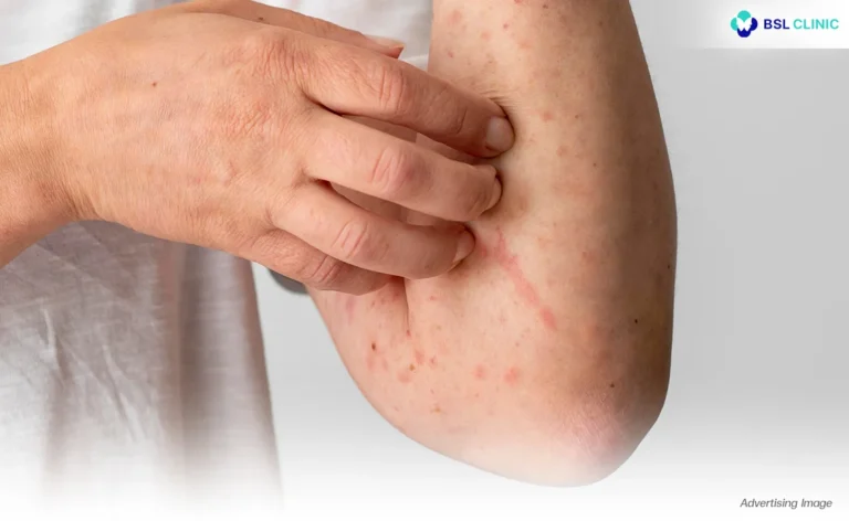 Chickenpox