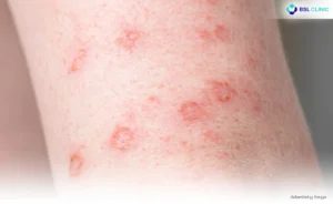 Dermatitis Eczema