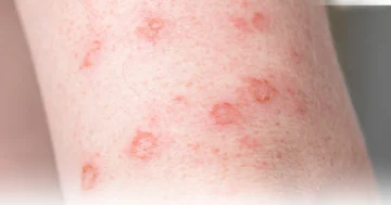 Dermatitis Eczema