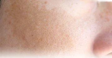 The Causes of Melasma