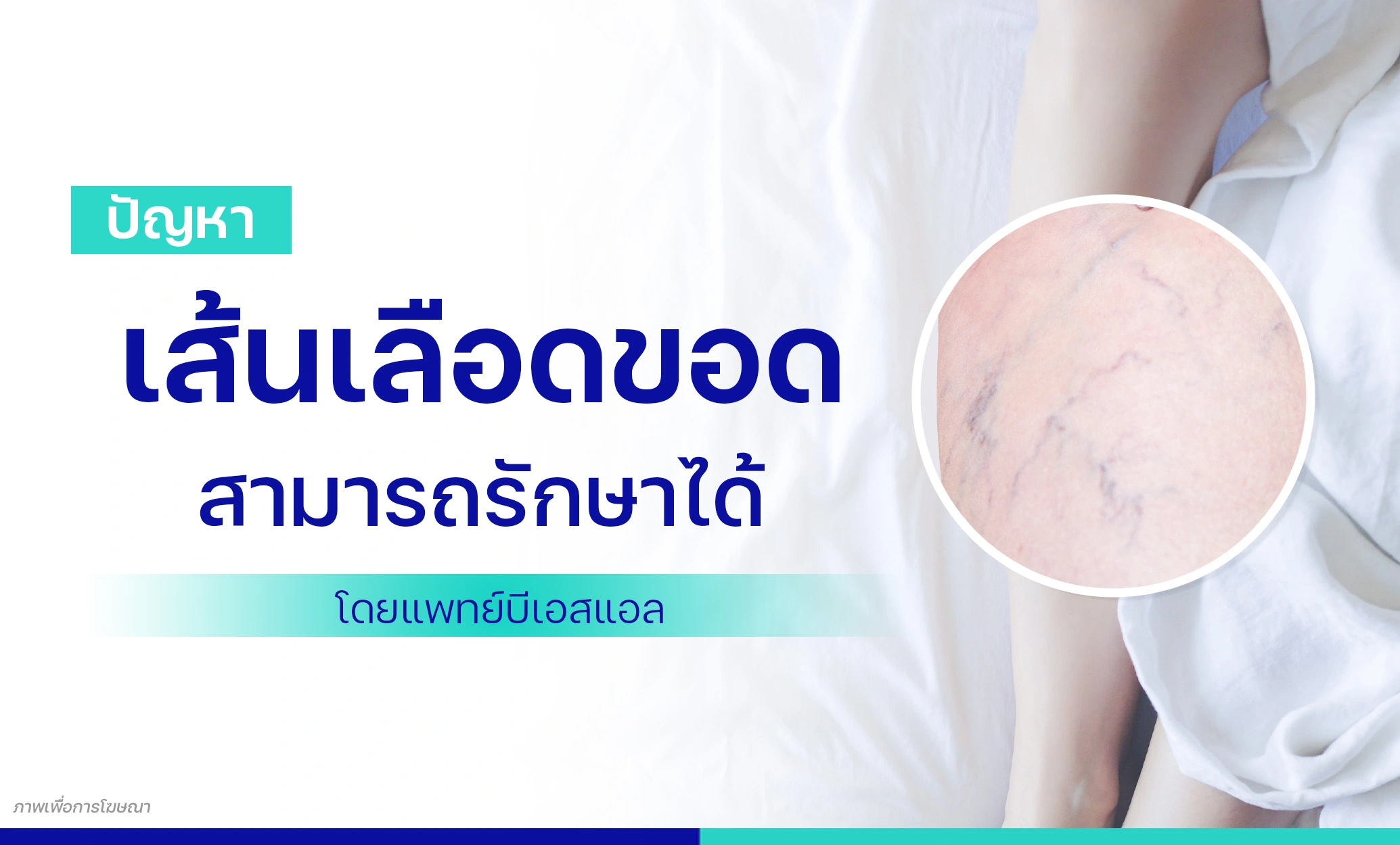 เส้นเลือดขอด