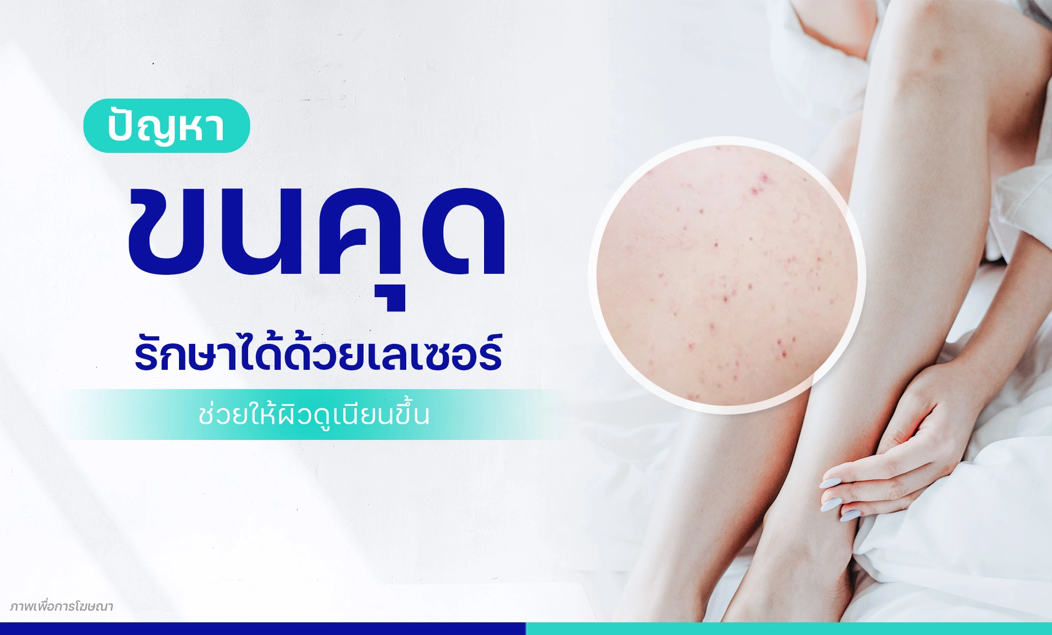 โปรแกรมรักษาขนคุด