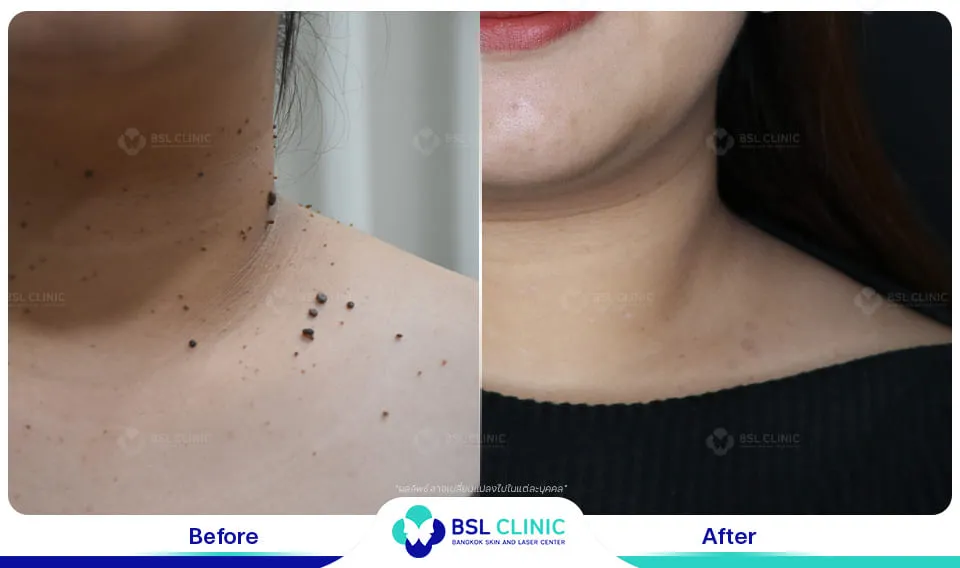 รักษาไฝ ขี้แมลงวัน ติ่งเนื้อ กระเนื้อ ต่อมเหงื่อใต้ตา