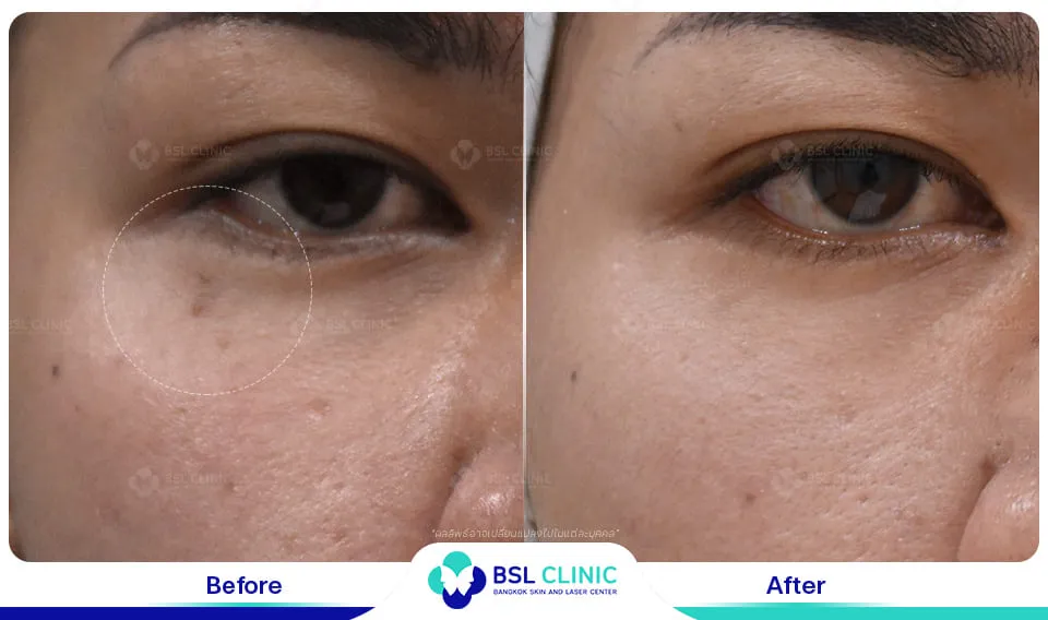 รักษา ขี้แมลงวัน ติ่งเนื้อ กระเนื้อ ต่อมเหงื่อใต้ตา