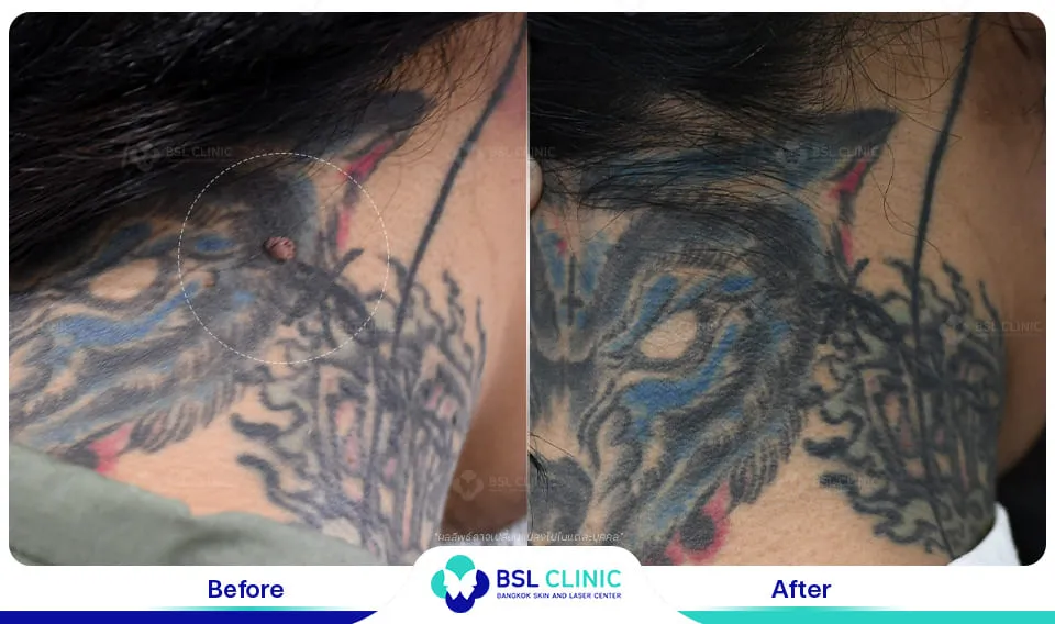 รักษา ขี้แมลงวัน ติ่งเนื้อ กระเนื้อ ต่อมเหงื่อใต้ตา