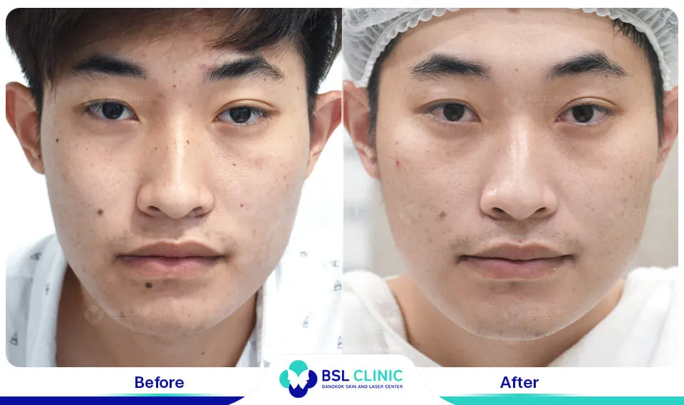 โปรแกรมรักษาไฝ