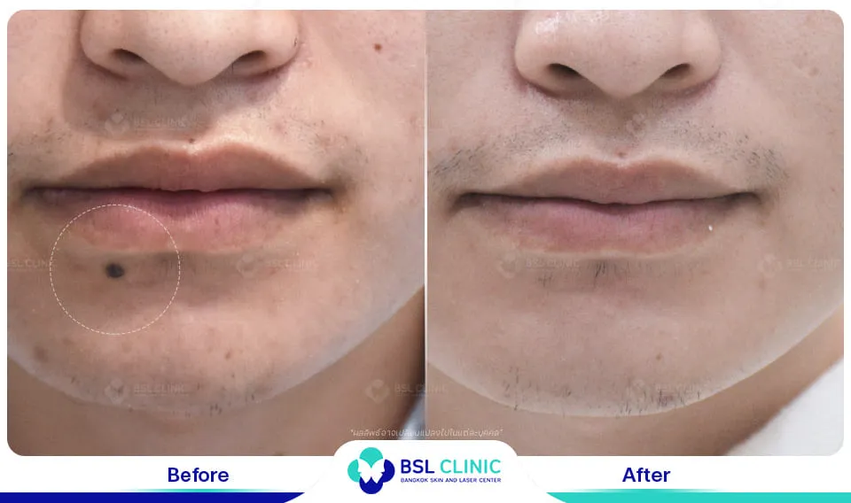 โปรแกรมรักษาไฝ