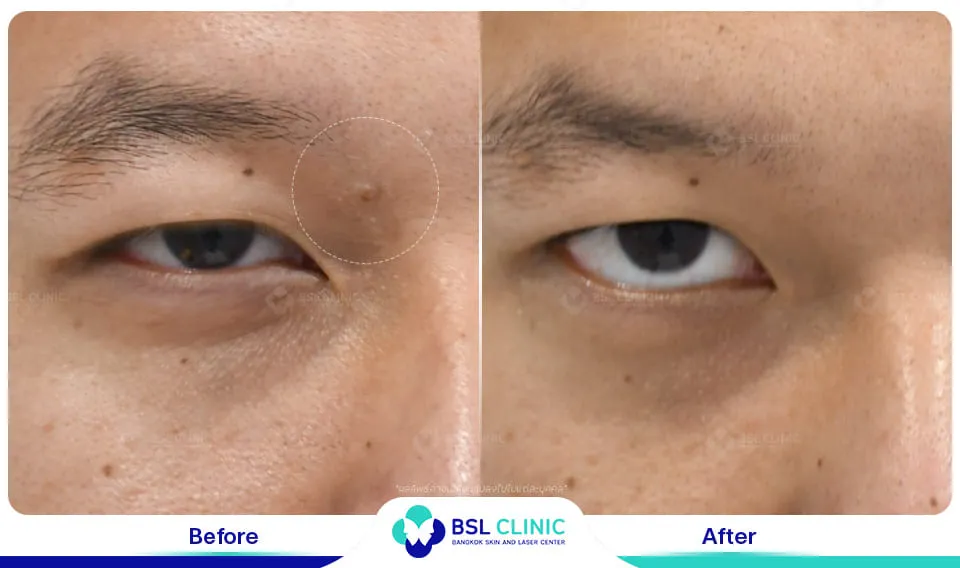 ผลลัพธ์การรักษาติ่งเนื้อ