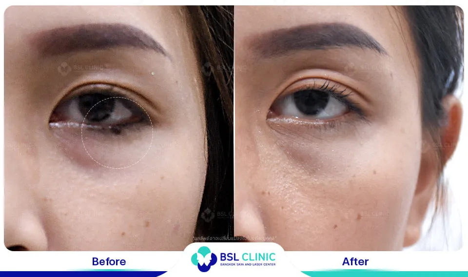 รักษาไฝใต้ตา