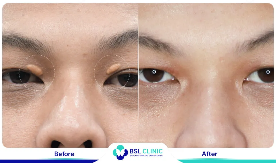 รักษาติ่งเนื้อ