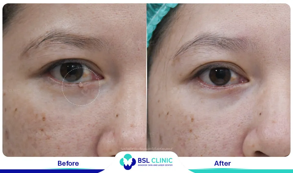 รักษาติ่งเนื้อใต้ตา