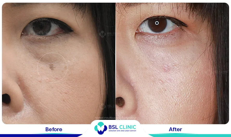 รักษา กระเนื้อ ต่อมเหงื่อใต้ตา