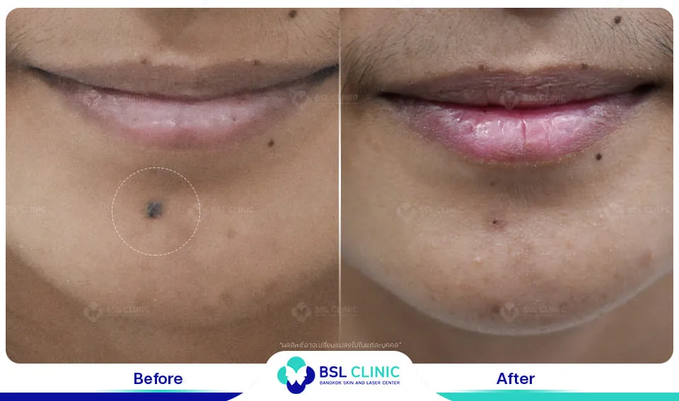 รักษาไฝ