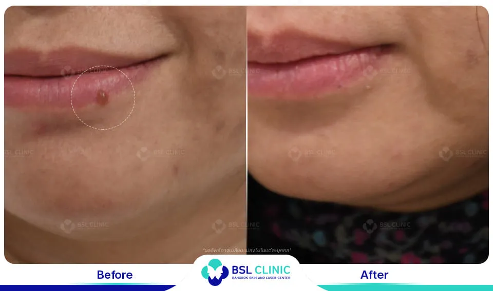 รักษาติ่งเนื้อ