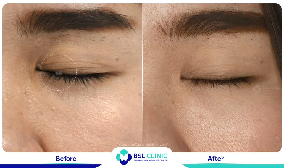 รักษาไฝใต้ตา