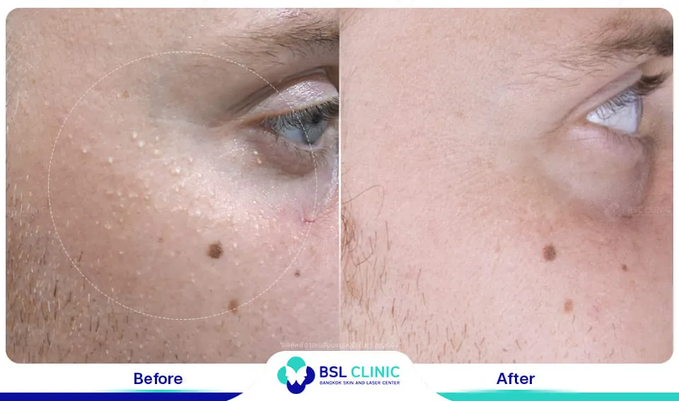 รักษากระเนื้อ