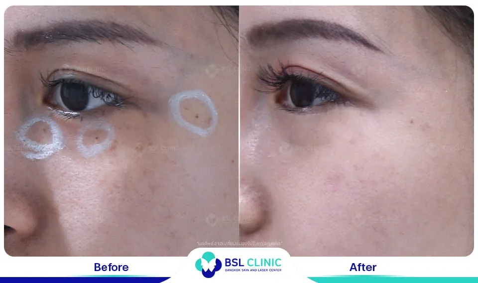 รักษาขี้แมลงวัน