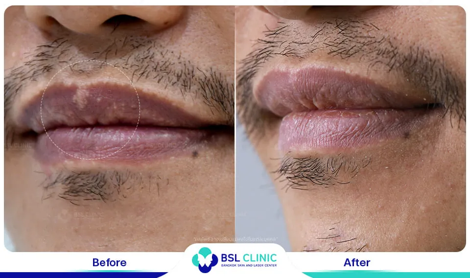 รักษาFordyce