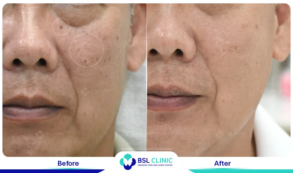 รักษาติ่งเนื้อ กระเนื้อ ต่อมเหงื่อใต้ตา