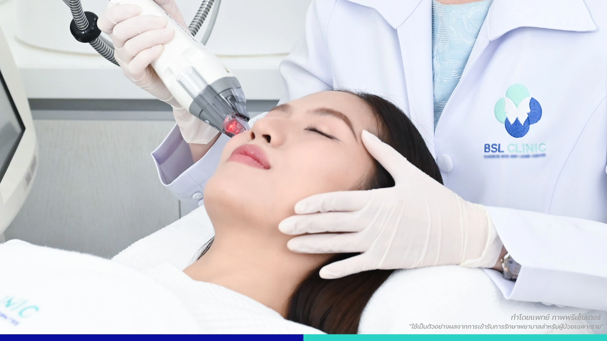 ข้อดีของเลเซอร์รักษาหลุมสิว