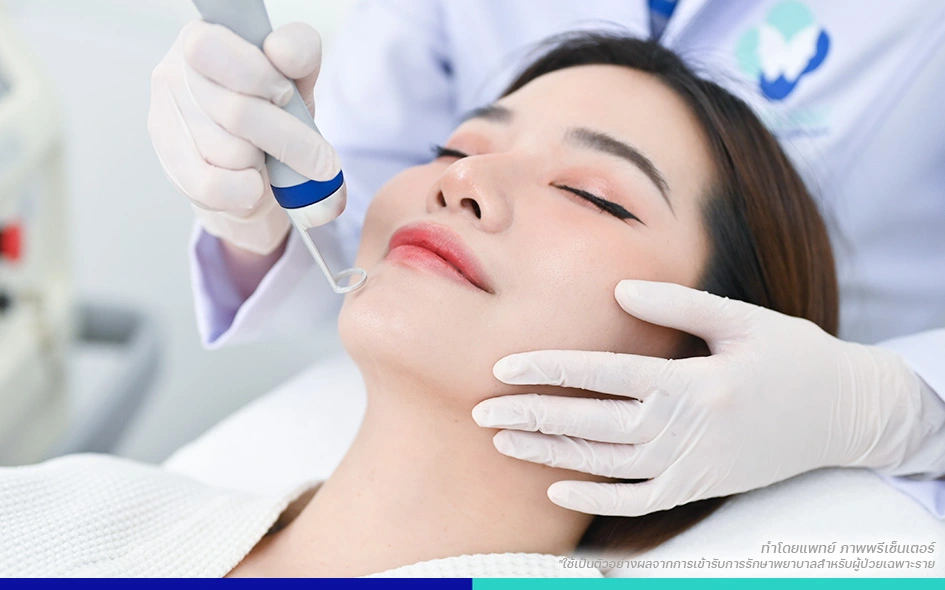 รักษาสิว pico