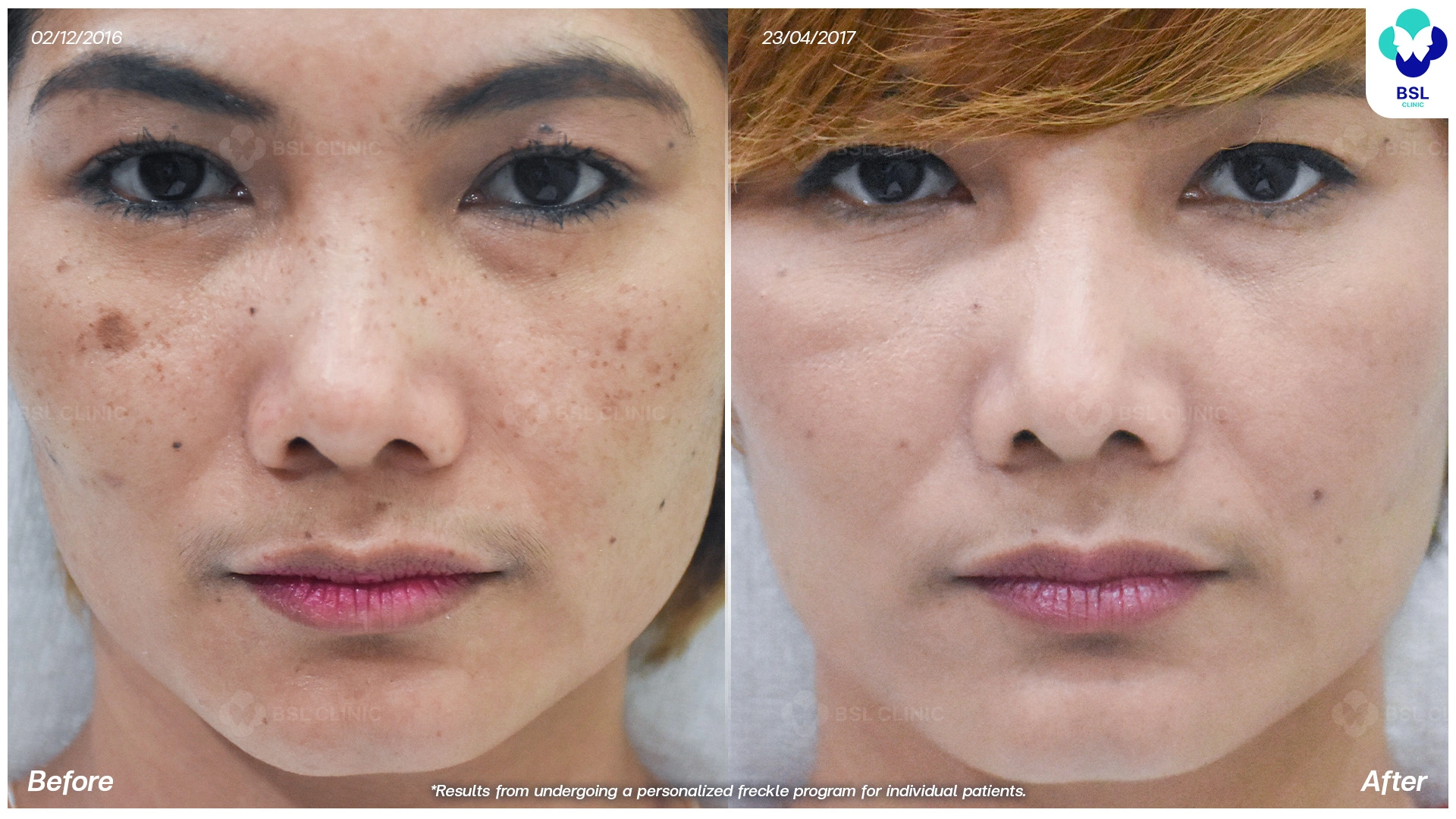 โปรแกรมรักษากระ