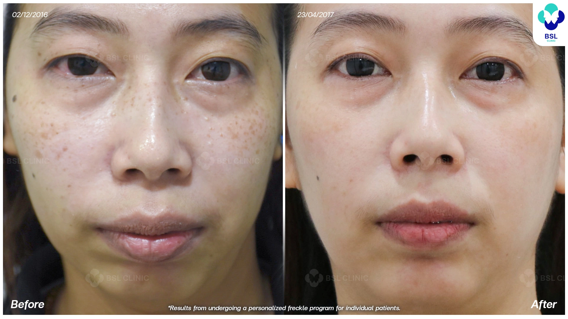 กระบนใบหน้า