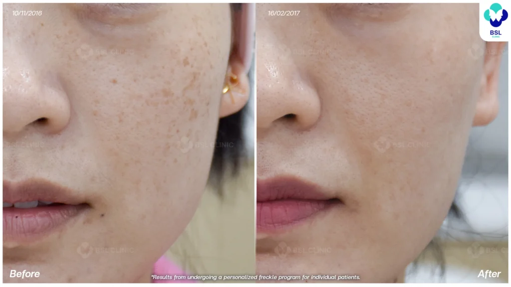 รักษากระจากเคสจริง