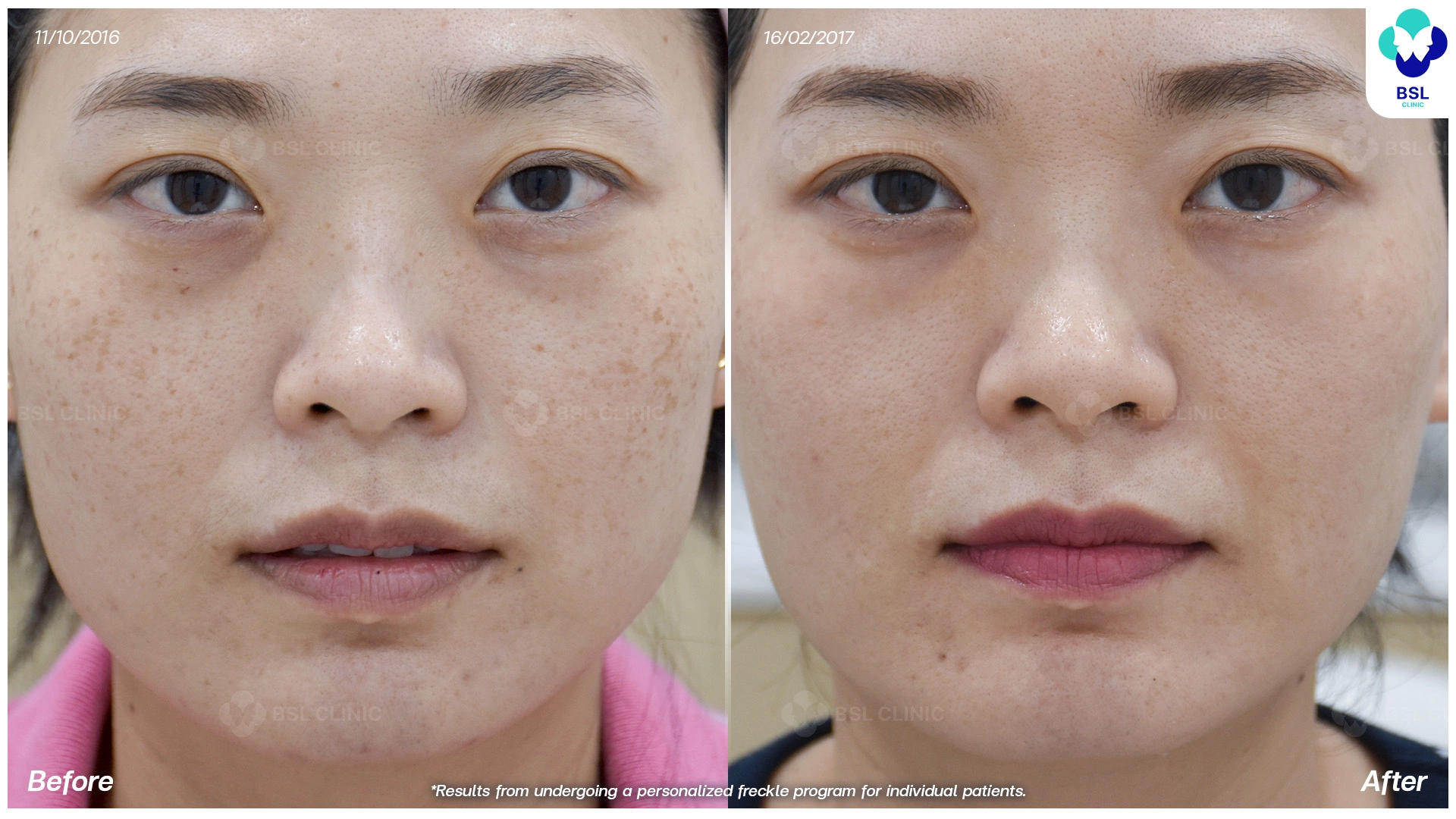 ผลลัพธ์รักษากระ