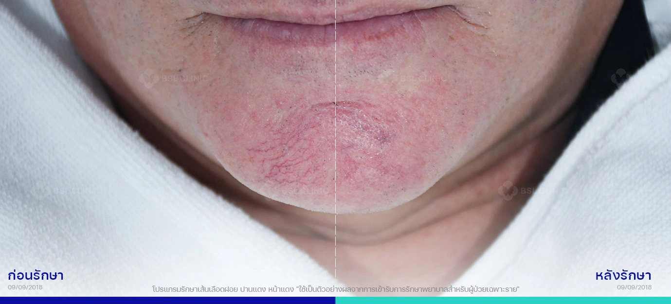 หน้าแดง ก่อน-หลังรักษาเส้นเลือดฝอย