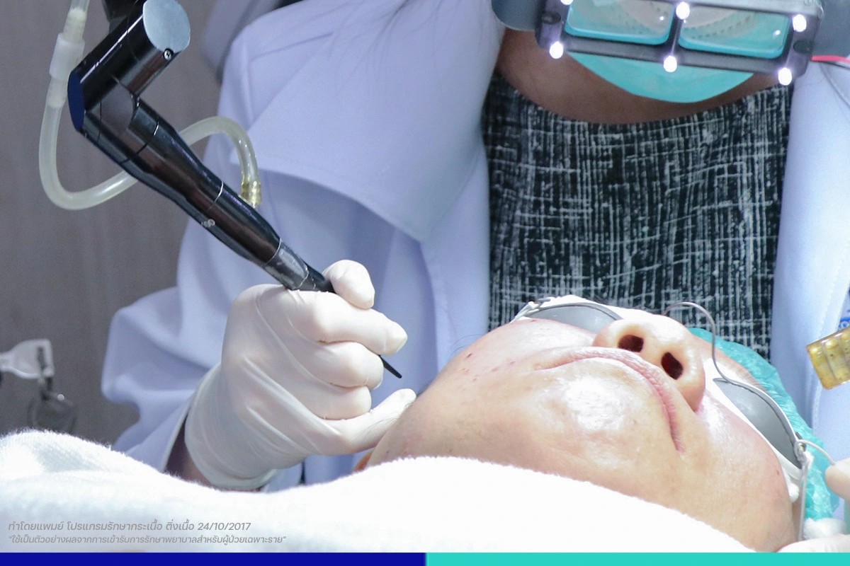 ขั้นตอนการรักษา ไฝ, ขี้แมลงวัน, ติ่งเนื้อ, กระเนื้อ, ต่อมเหงื่อใต้ตา