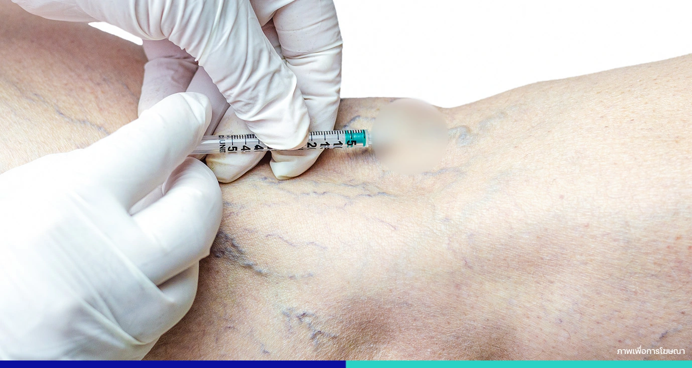 ฉีดเส้นเลือดขอด