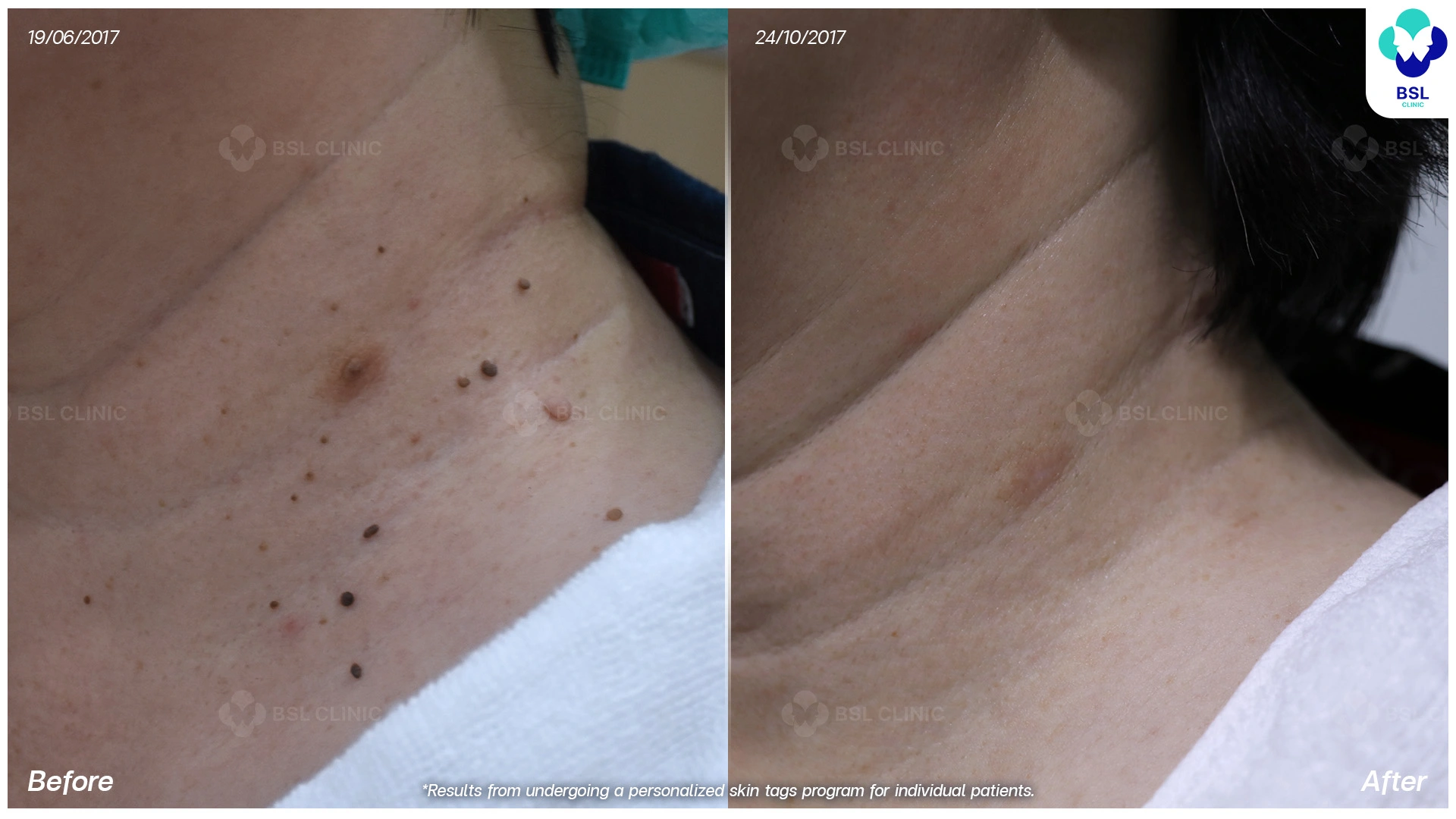 รักษาไฝ ขี้แมลงวัน ติ่งเนื้อ กระเนื้อ ต่อมเหงื่อใต้ตา