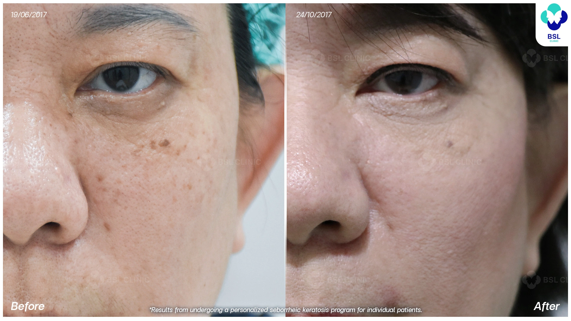 รักษาไฝ ขี้แมลงวัน ติ่งเนื้อ กระเนื้อ ต่อมเหงื่อใต้ตา