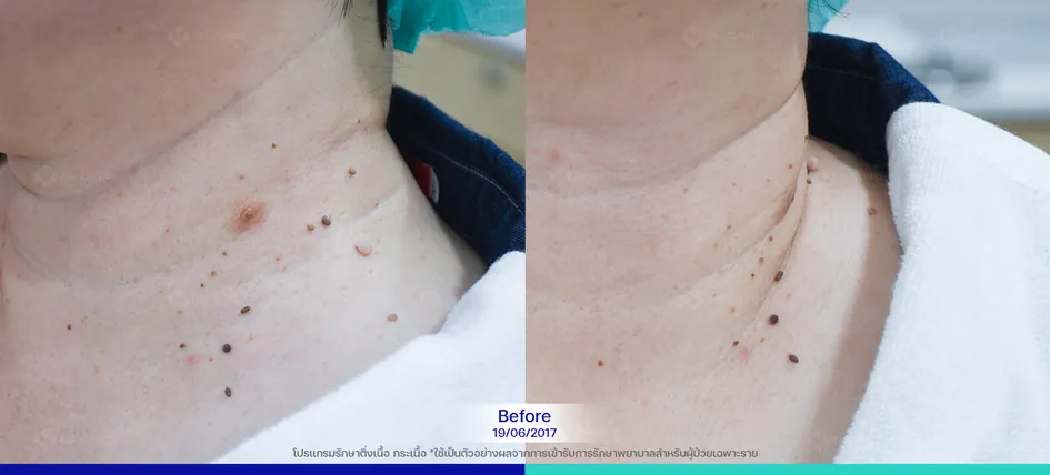 ติ่งเนื้อ กระเนื้อ ก่อนรักษา