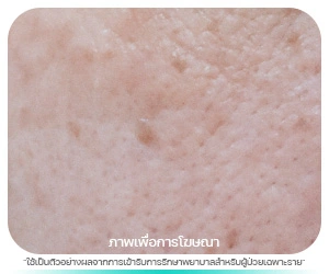 กระเนื้อ (Seorrheic Keratosis)