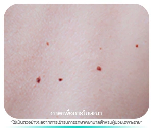 ขี้แมลงวัน (Melanocytic Nevus)