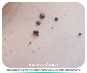ติ่งเนื้อ (Skin Tag)