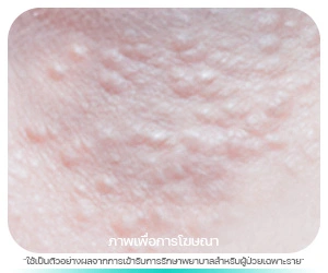 ต่อมเหงื่อรอบดวงตา (Syringoma)