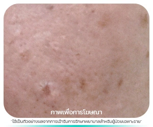 เนื้องอกต่อมไขมัน (Sebaceous Gland Hyperplasia)