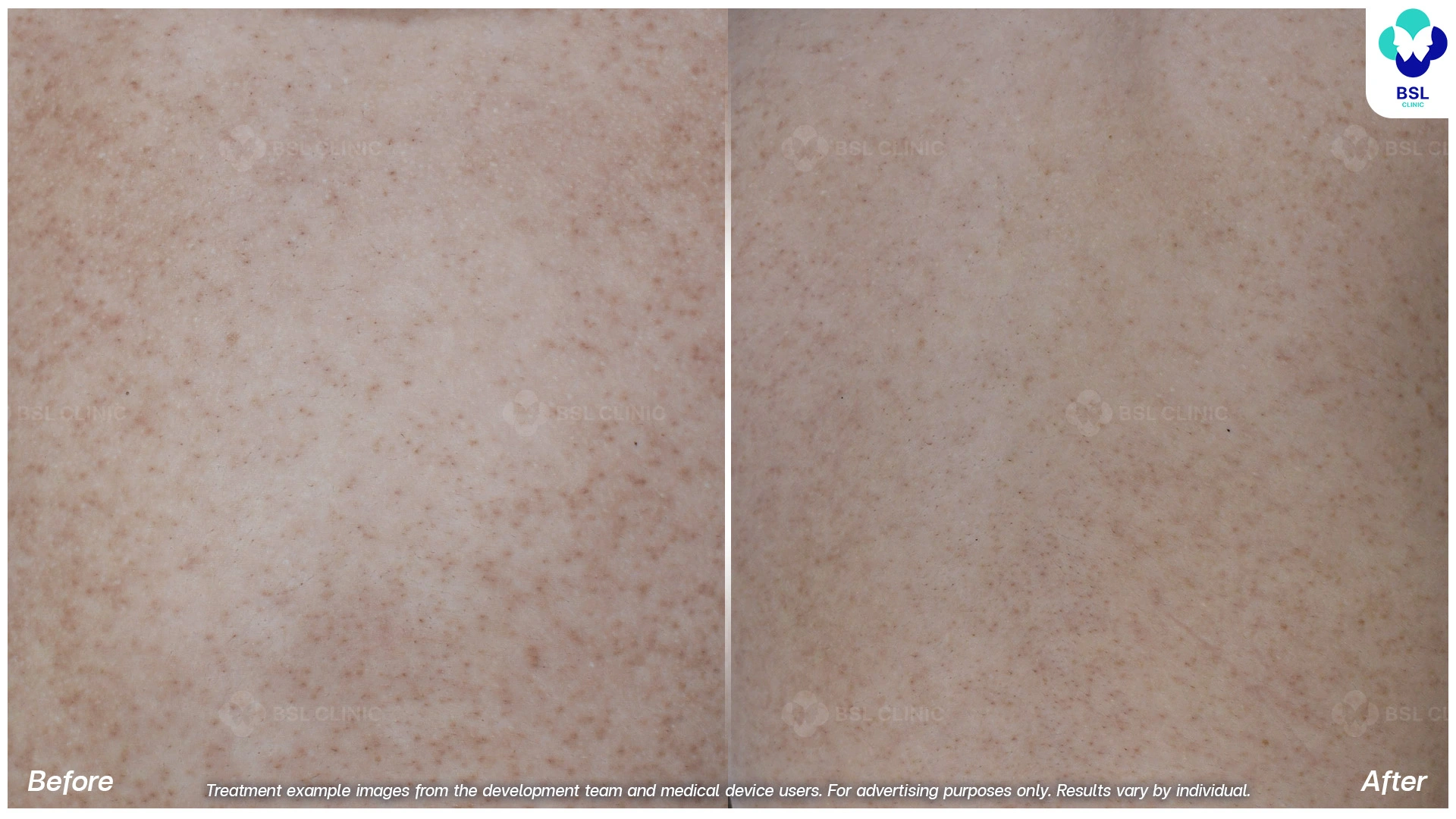 รักษาขนคุด