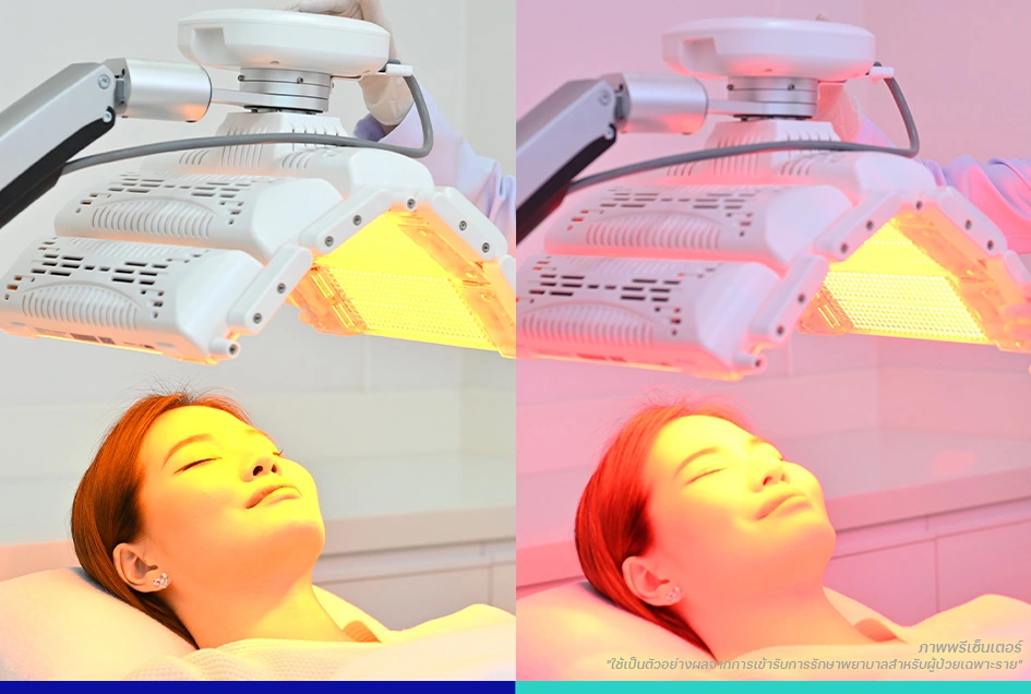 ผิวแพ้ง่าย ฉายแสง ลดสิว