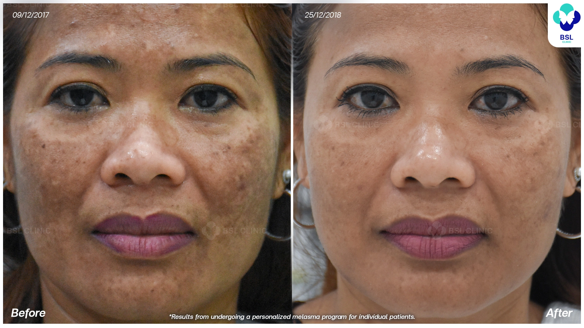 รักษาฝ้า