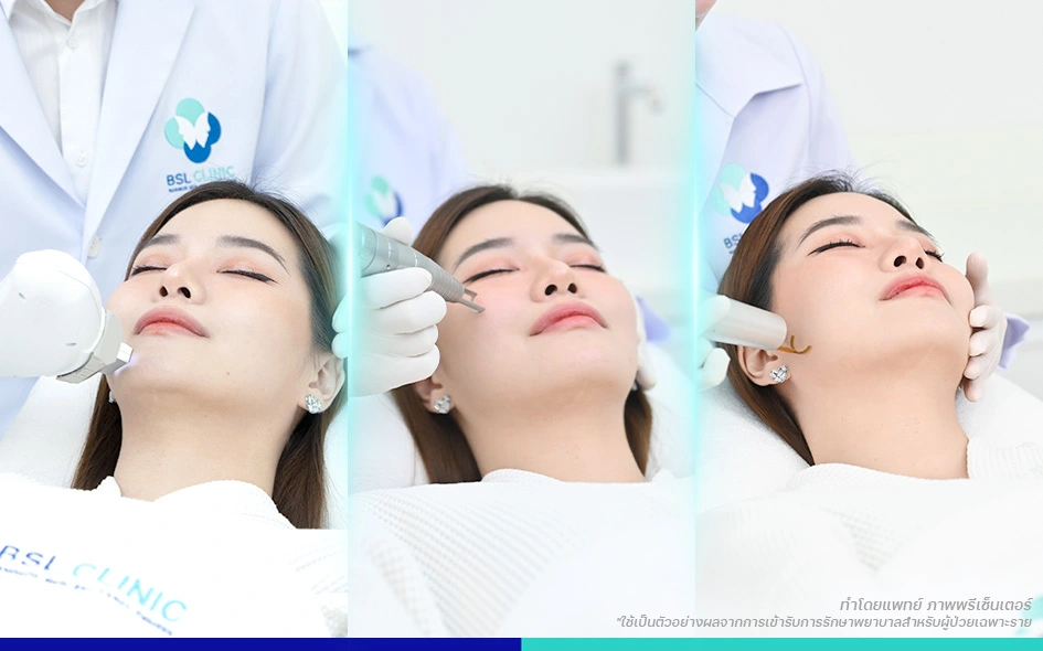 รักษาสิว รอยสิว