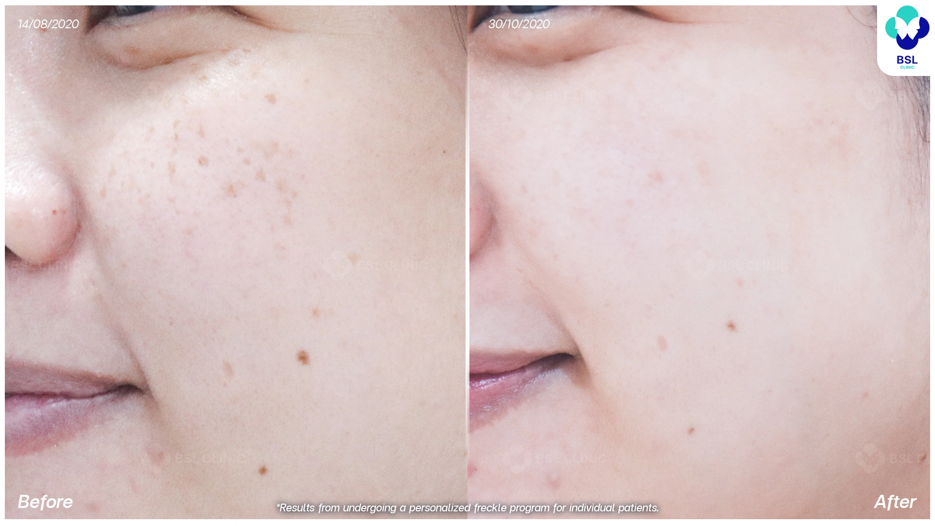 รีวิวรักษากระ