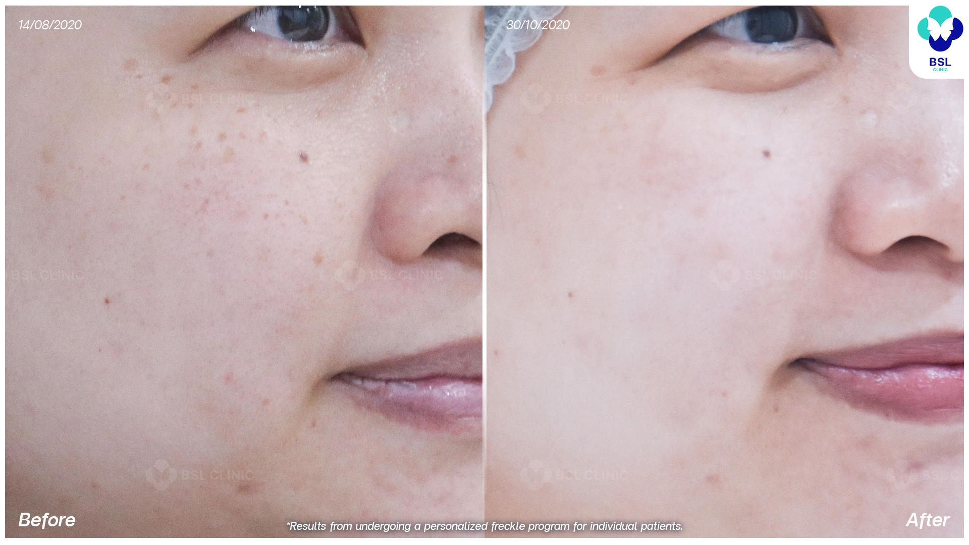 รีวิวรักษากระที่แก้ม