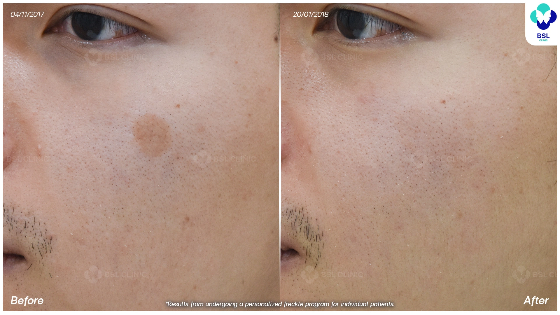 รักษากระแดด