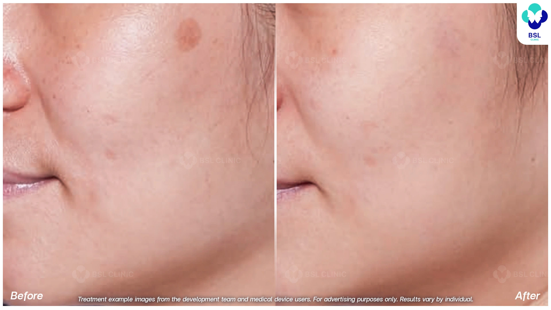 รักษากระโปรแกรม picoway