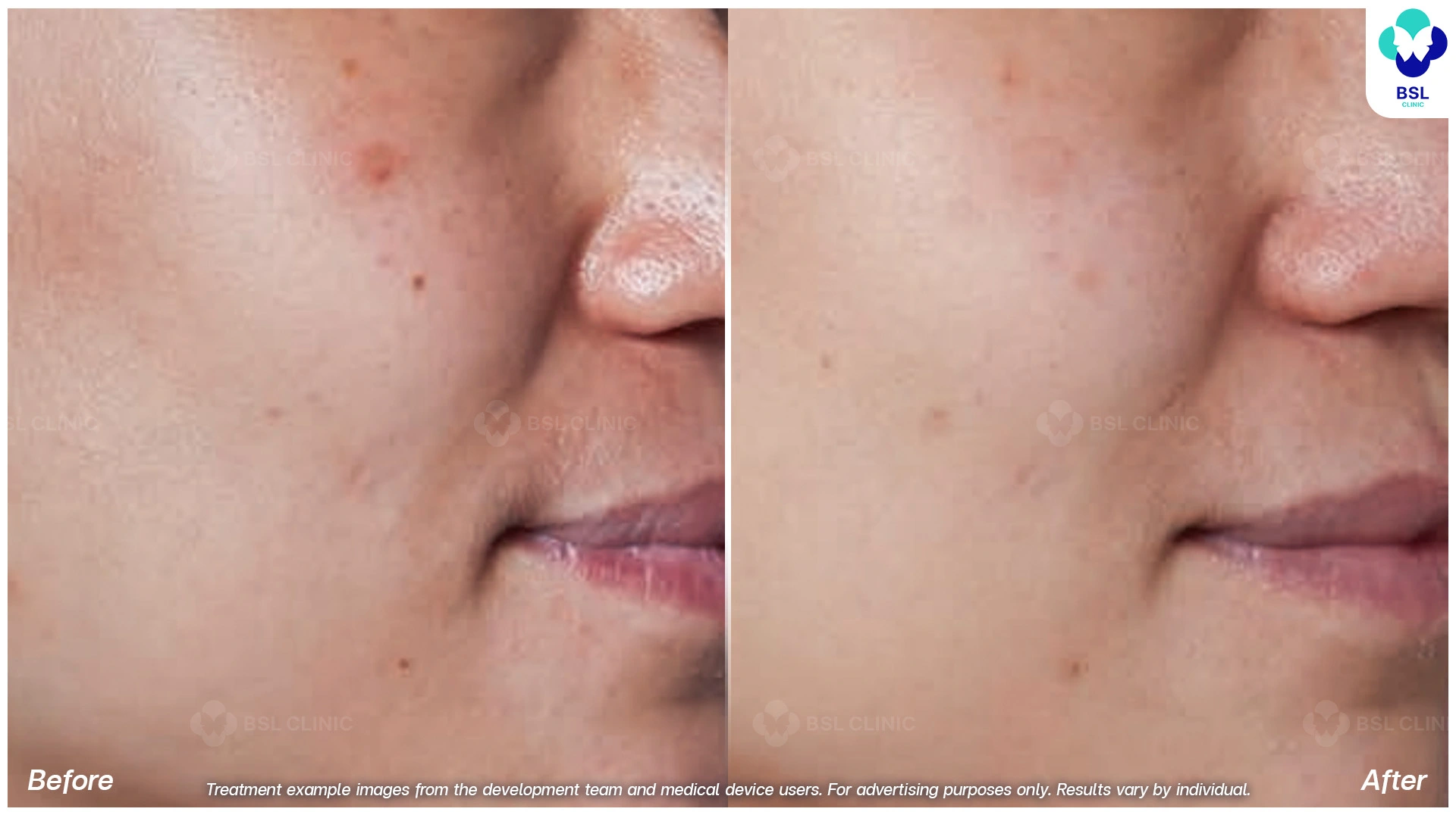 รักษากระโปรแกรม picoway