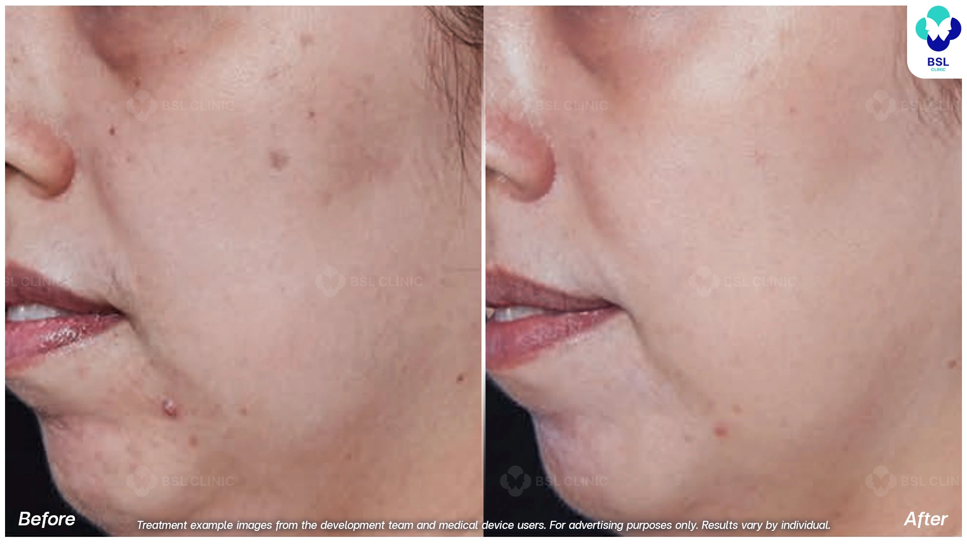 โปรแกรม picoway รักษากระ